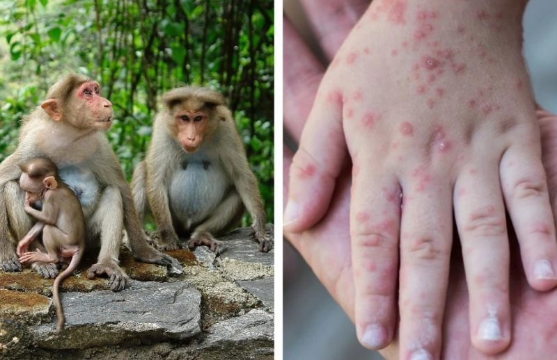 Numărul de cazuri de variola maimuțelor crește în continuare