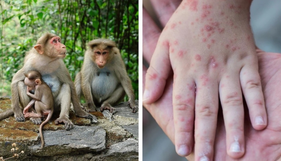 Numărul de cazuri de variola maimuțelor crește în continuare