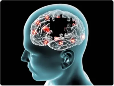 Primul medicament împotriva Alzheimer cu adevărat eficient